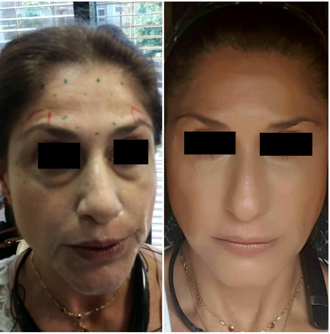 botox in north miami beach fl